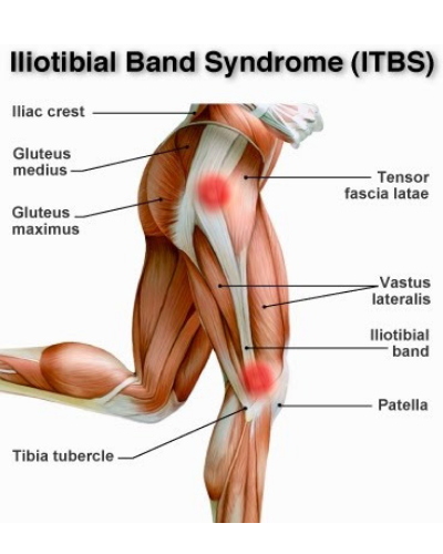 Knee Pain Running Downhill: ITB